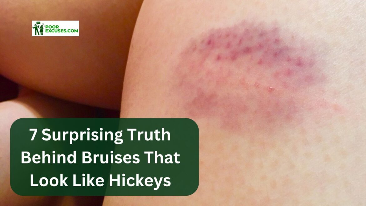 Bruises That Look Like Hickeys Bruises That Look Like Hickeys