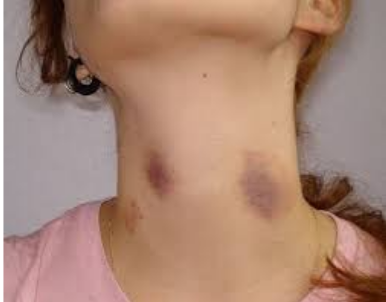 Bruises That Look Like Hickeys